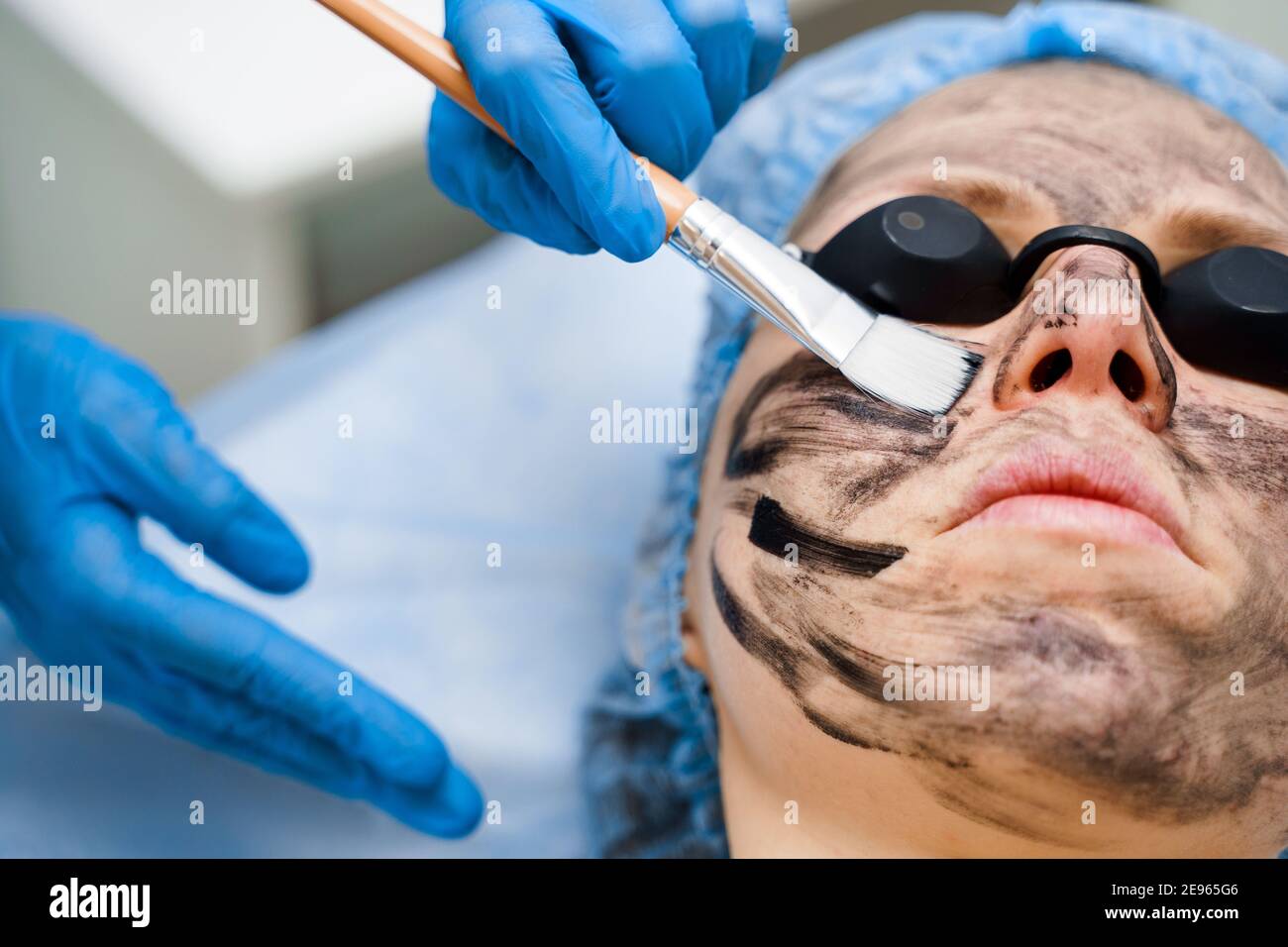 Le dermatologue smear un masque noir sur le visage pour le  photorajeunissement laser et le gommage au carbone. Dermatologie et  cosmétologie. Utilisation d'un laser chirurgical Photo Stock - Alamy