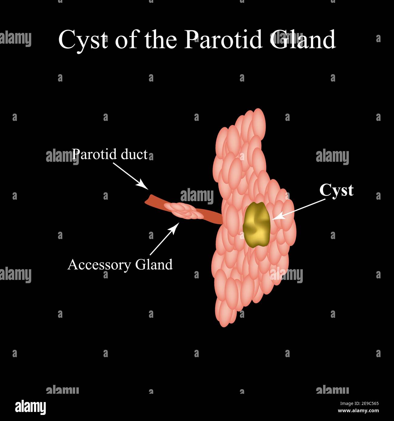 Kyste de la glande paratide salivaire. Structure de la glande salivaire parotide. Illustration vectorielle sur un arrière-plan isolé Illustration de Vecteur