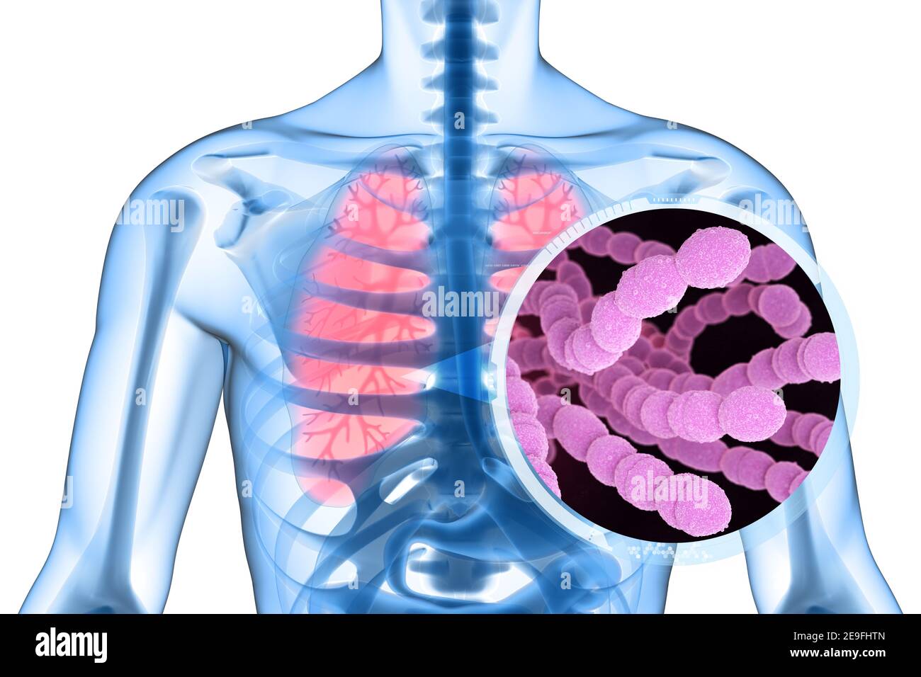 Streptococcus pneumoniae, ou pneumocoque, est une bactérie pathogène en forme de coccus Gram-positif qui cause de nombreux types d'infections pneumococciques dans l'annonce Banque D'Images