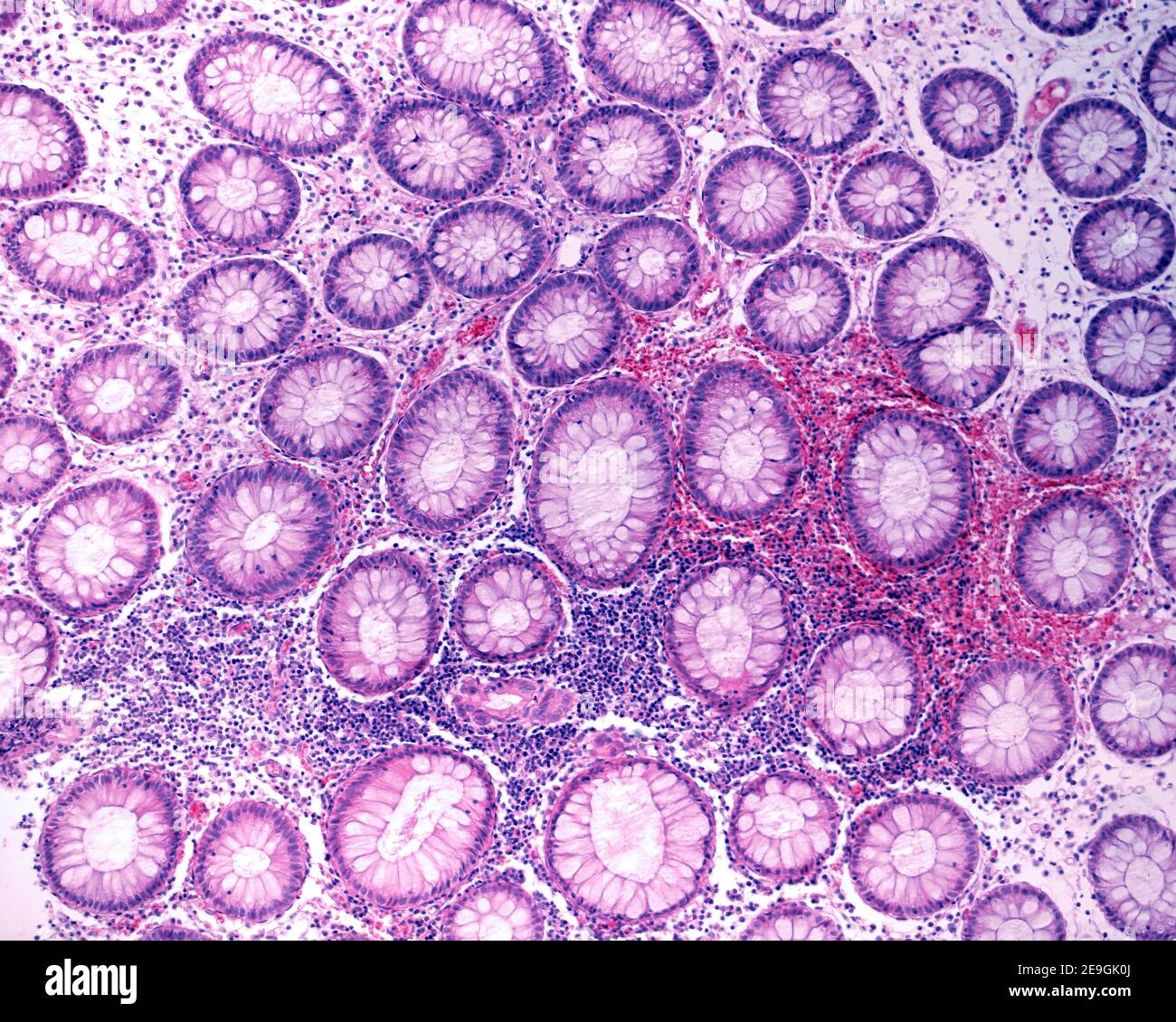 Coupe transversale des cryptes de Lieberkühn d'un côlon humain, parmi lesquelles il y a des cellules inflammatoires abondantes et des globules rouges. Banque D'Images