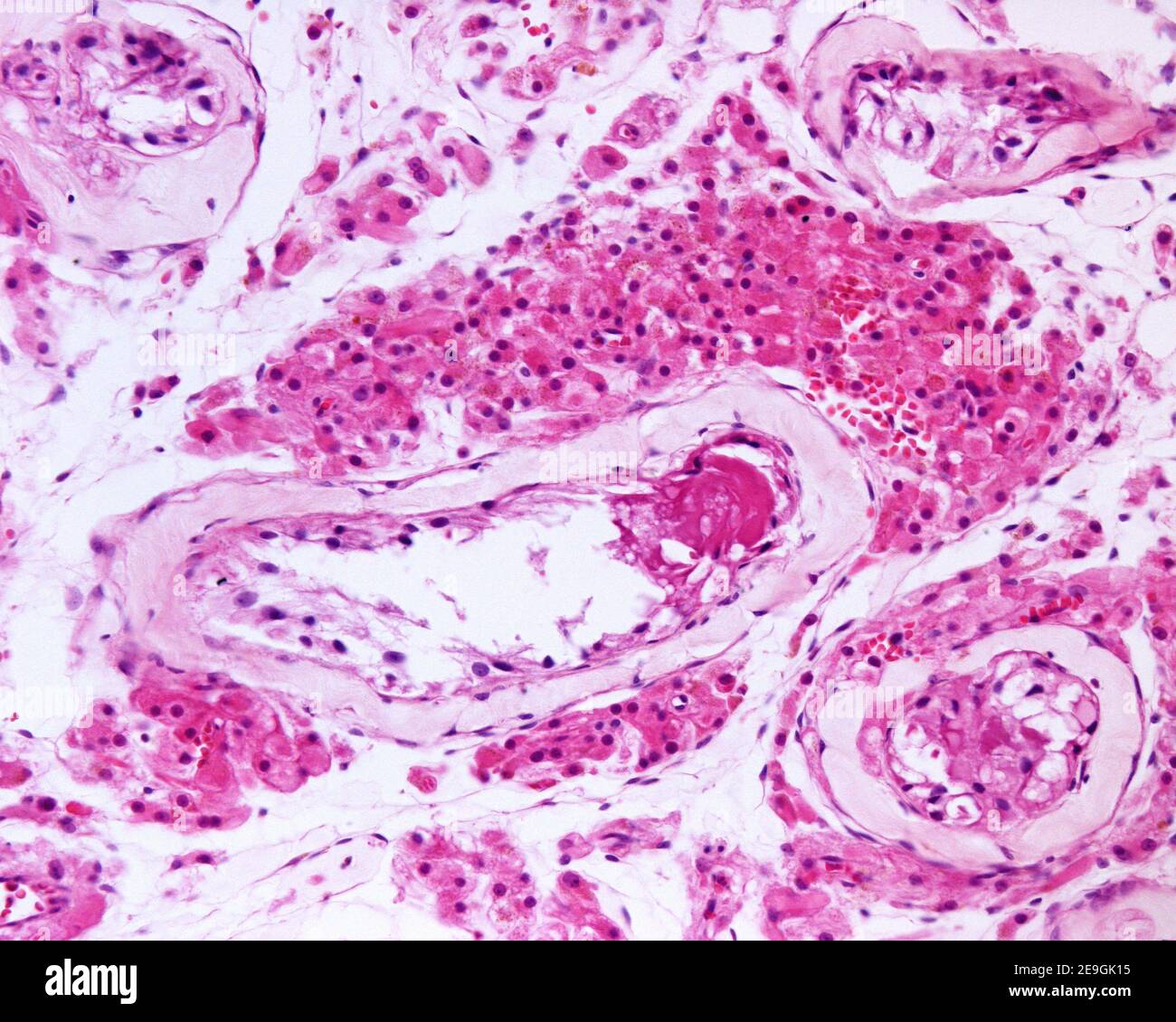 Grand groupe de cellules de Leydig dans un cas de syndrome de Klinefelter, caractérisé par un 47, XXY caryotype. L'hyperplasie de l'interstitium testiculaire Banque D'Images