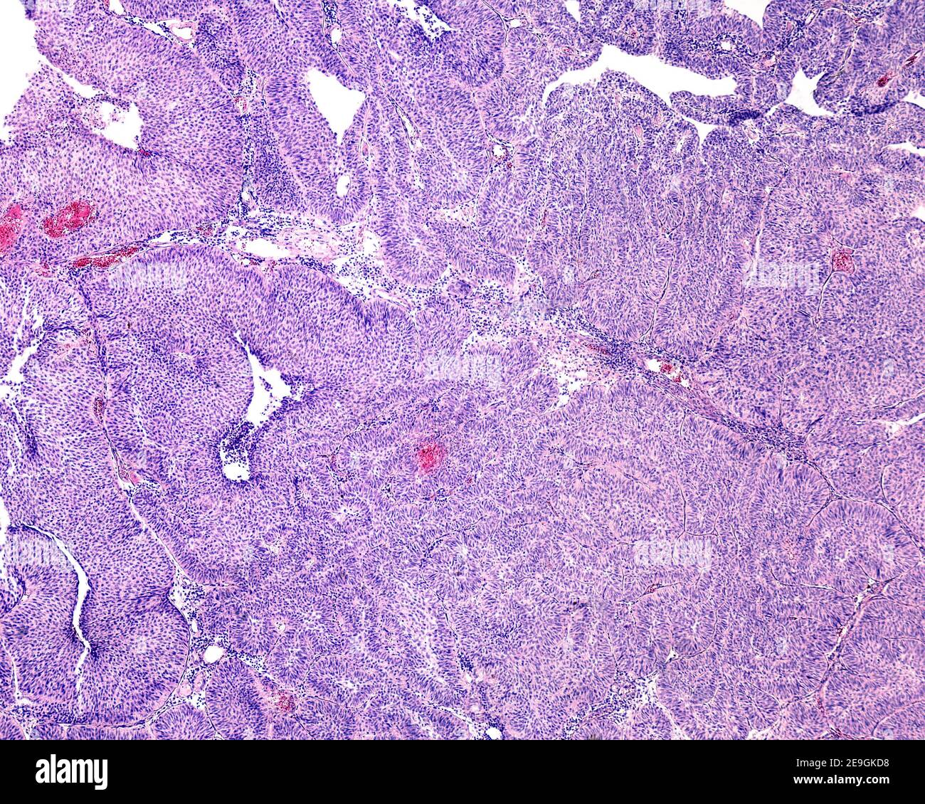 Image microscopique montrant un papillome de la vessie urinaire formé par des papilles avec noyau fibrovasculaire et recouvert d'un épithélium transitoire (urothélial). Banque D'Images