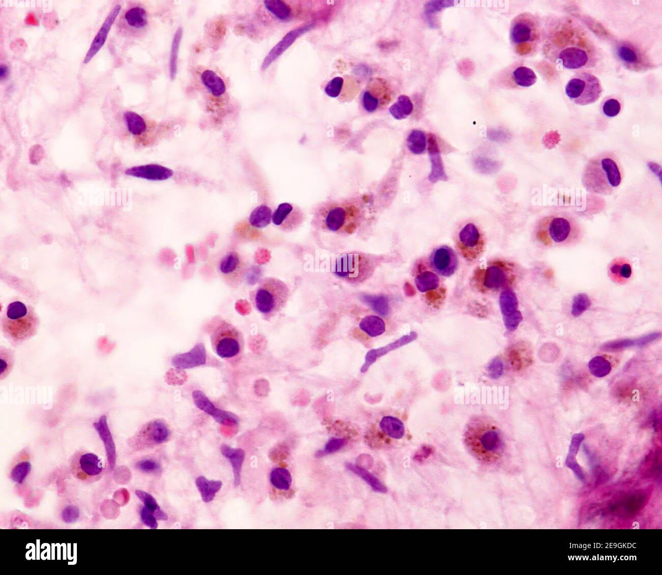 Histiocytes (macrophages) chargés de granules de pigment marron d'hémosidéraine. Ces cellules apparaissent dans les tissus après les hémorroïdes. Banque D'Images