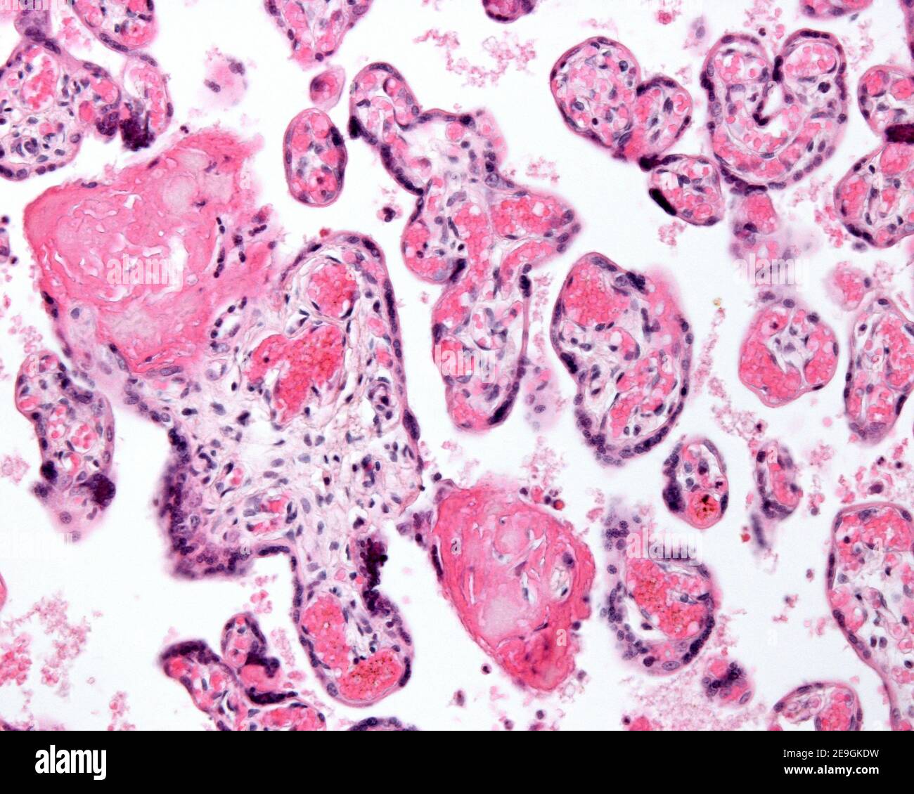 Placenta hypermature ou vieillissant. Les petits villosités chorioniques montrent de nombreux vaisseaux sanguins fœtaux, des nœuds syncytiaux et des amas de fibrine. Banque D'Images