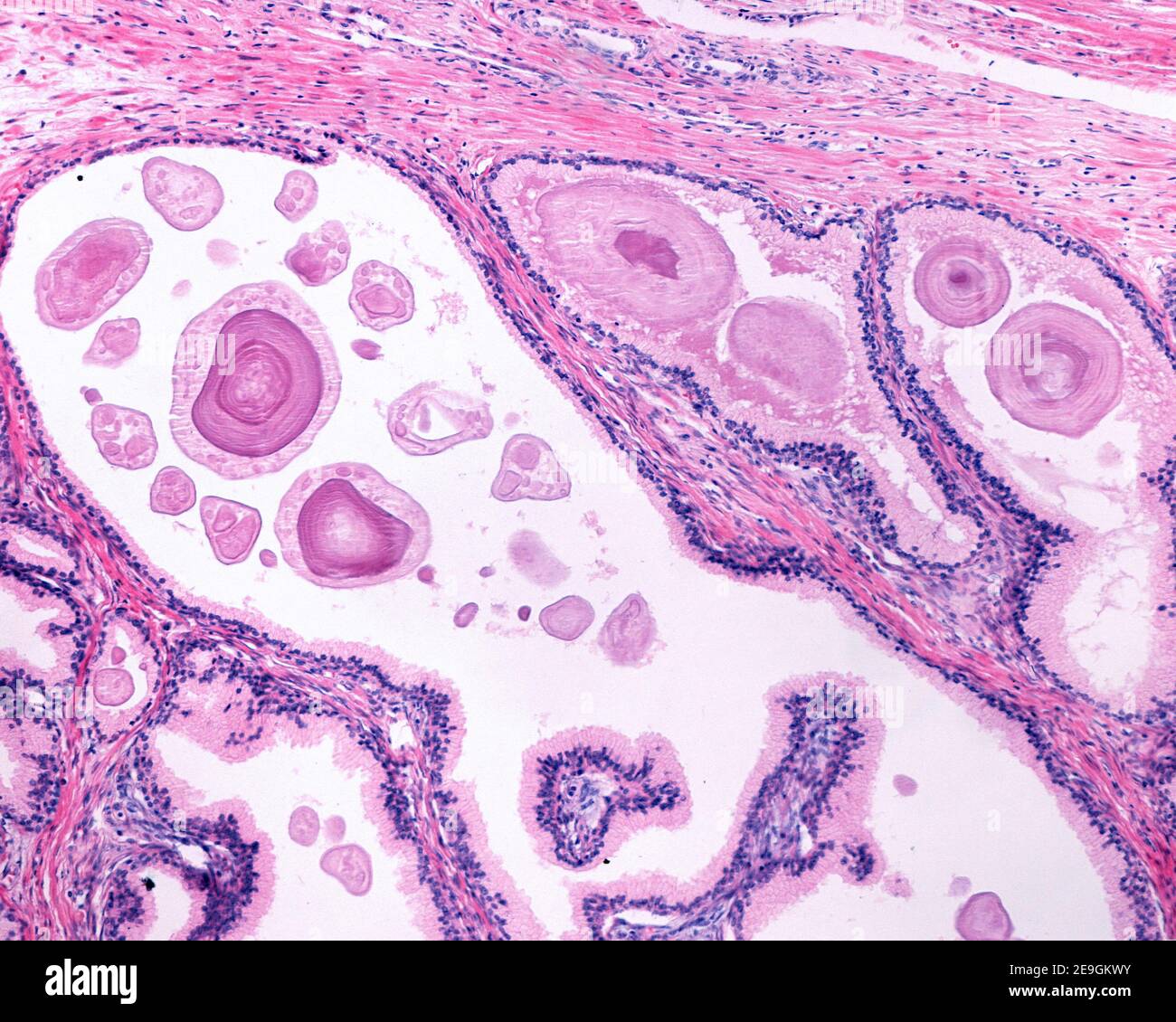 Corpora amylacea (concrétions prostatiques) situé dans la lumière des glandes de la prostate humaine chez un homme plus âgé. Elles apparaissent sous forme de grande structure ronde ou ovale Banque D'Images