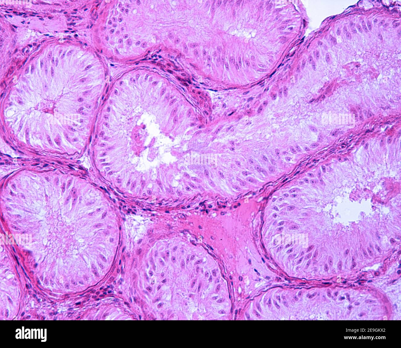 Testicule en cas de syndrome de Sertoli seul ou d'aplasie des cellules germinales. Les tubules séminifères ne montrent que des cellules de Sertoli. Banque D'Images