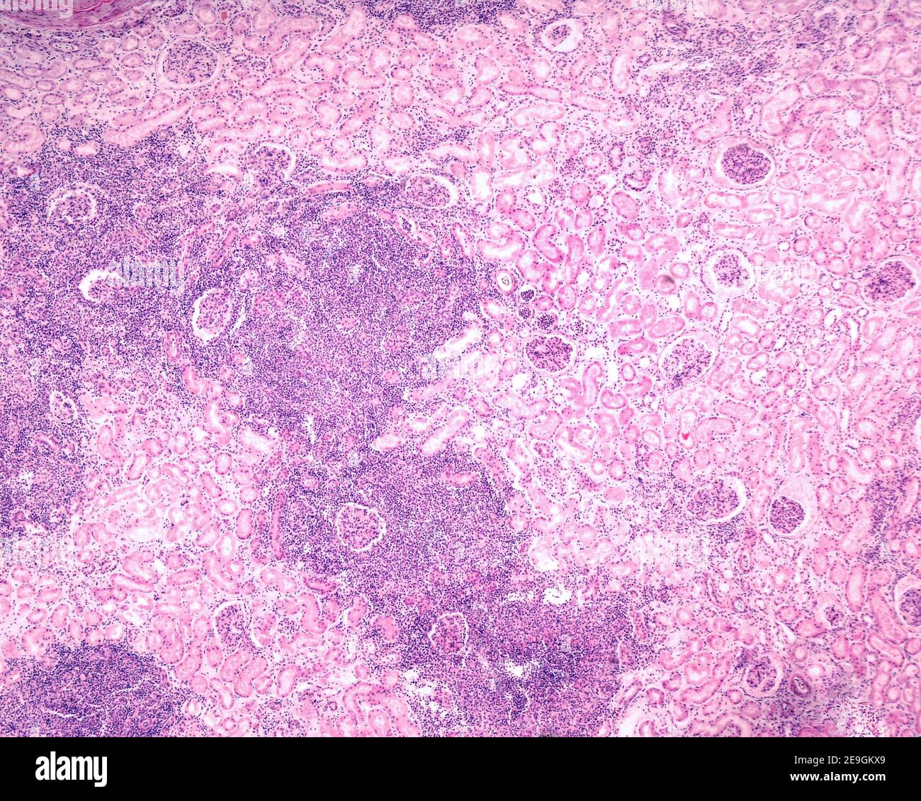 Micrographe à faible grossissement montrant un rein affecté par une pyélonéphrite chronique. De très grands nodules de cellules inflammatoires chroniques occupent une grande partie de la TH Banque D'Images