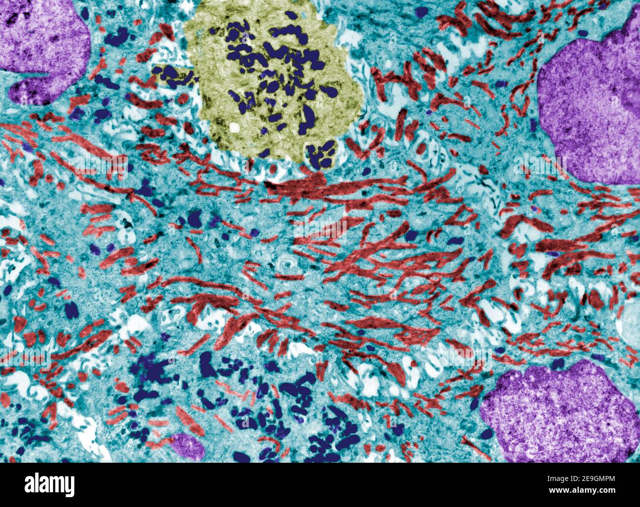 Micrographe à microscope électronique de fausse couleur montrant les granules de mélanine (bleu foncé) dans un mélanocyte (jaune) et dans plusieurs kératinocytes (bleu clair) wi Banque D'Images
