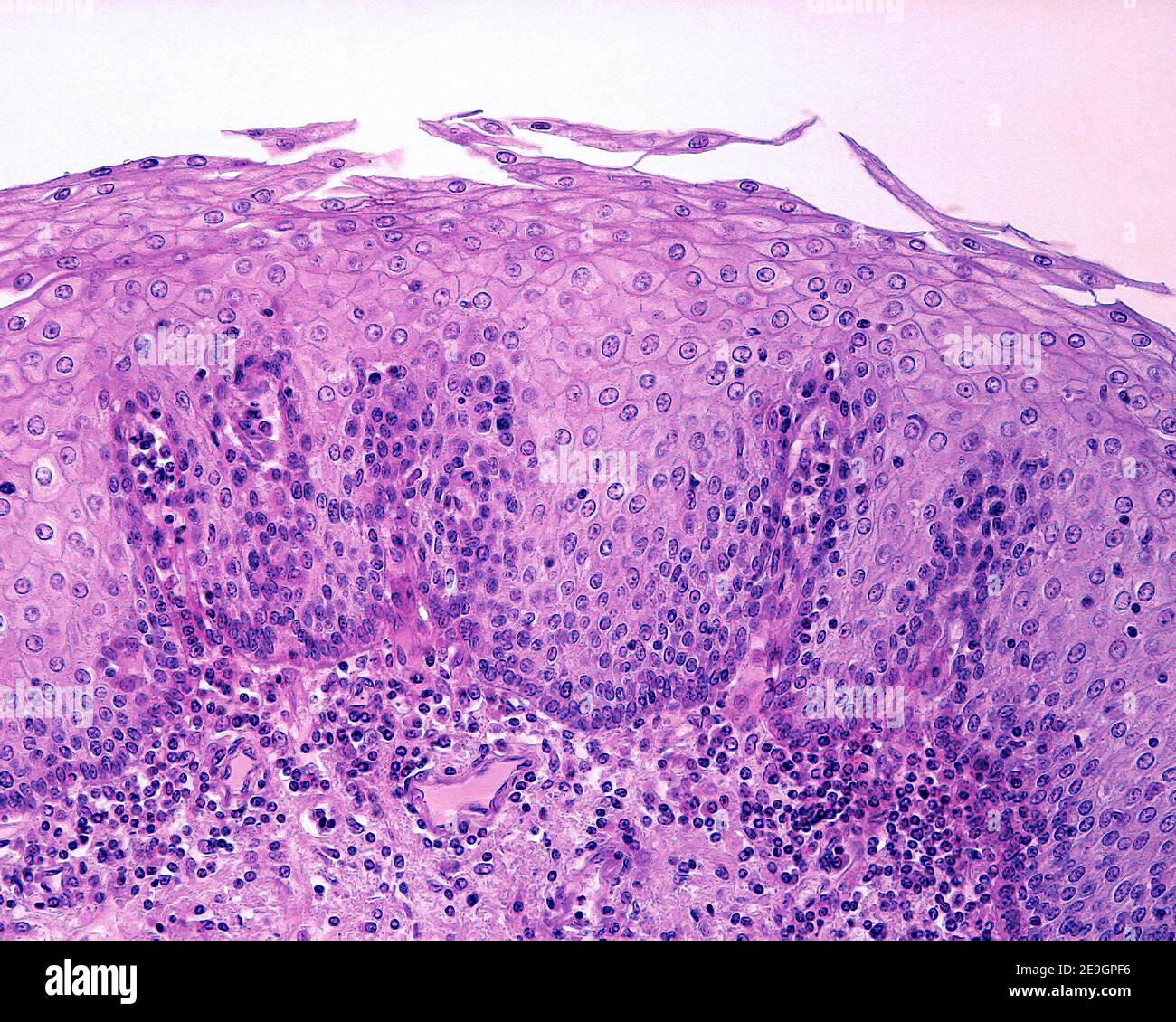 Doublure épithéliale de l'œsophage. Il s'agit d'un épithélium squameux stratifié non kératinisé, dont les cellules les plus superficielles conservent leurs noyaux Banque D'Images