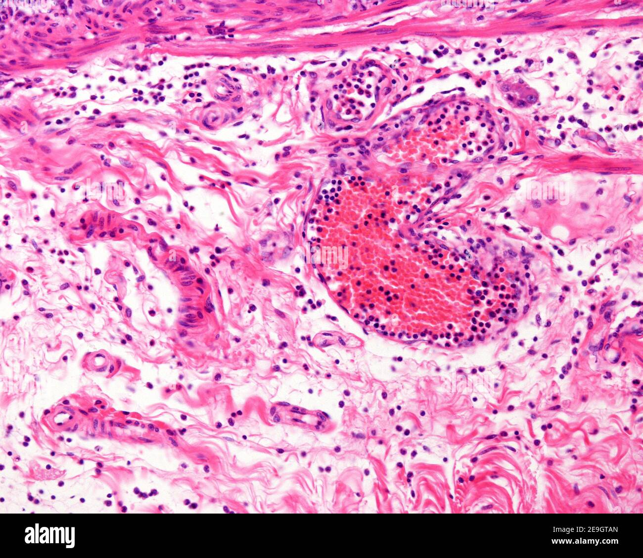 Vaisseau sanguin avec des leucocytes abondants dans la sous-muqueuse d'un diverticule enflammé de Meckel. Le tissu conjonctif montre également de nombreuses cellules inflammatoires. Banque D'Images