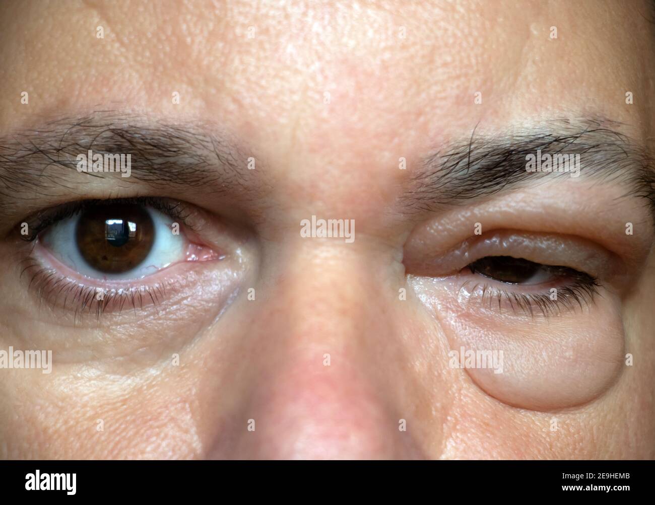 L'inflammation de la paupière. Enflure de l'œil après la piqûre d'insecte. Un homme aux yeux malades. Réaction sensible à une crème de rides expérimentale. Banque D'Images