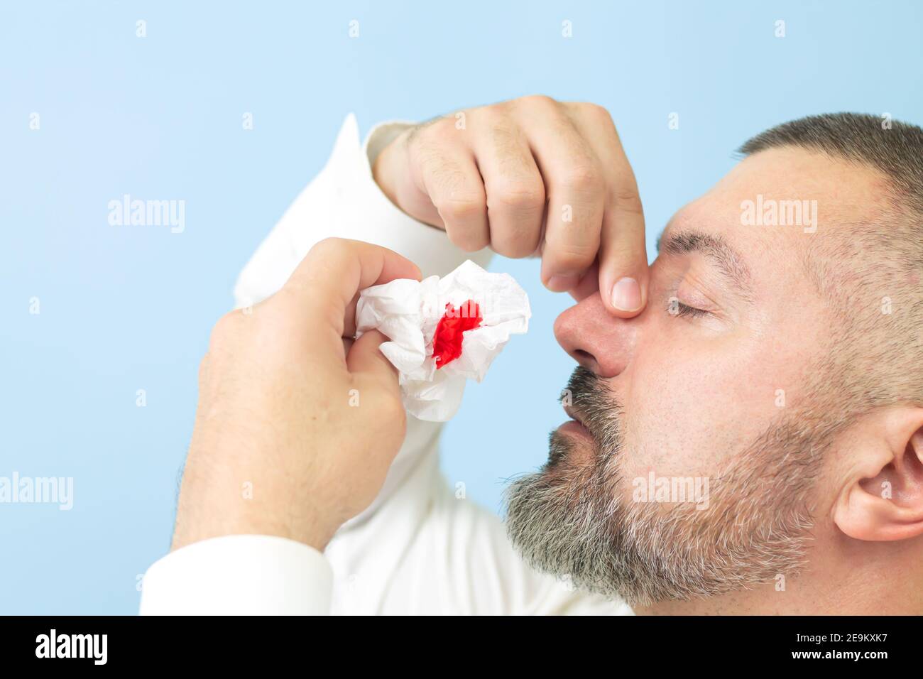 Homme souffrant de saignements de nez ou d'épistaxis et utilisant du papier de soie pour arrêter le saignement. Concept de soins de santé Banque D'Images