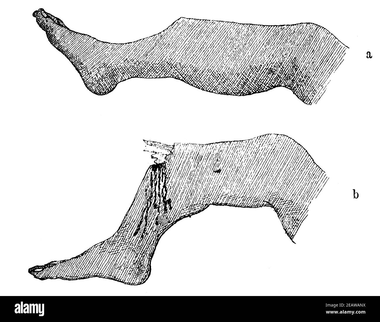 Fracture de jambe simple et complexe (fracture ouverte). Illustration du 19e siècle. Allemagne. Arrière-plan blanc. Banque D'Images