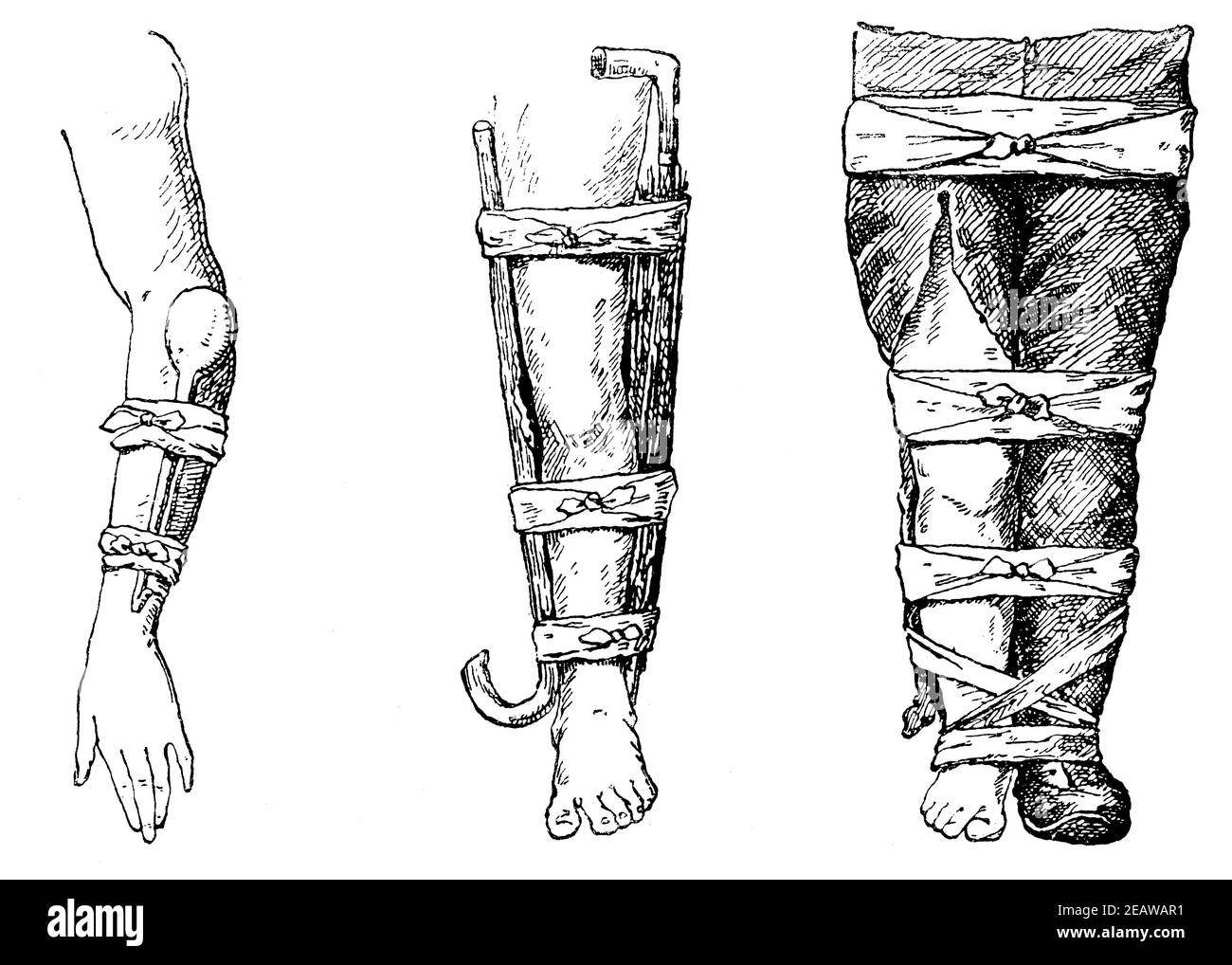 Exemples de fixation de membre en cas de fractures. Illustration du 19e siècle. Allemagne. Arrière-plan blanc. Banque D'Images