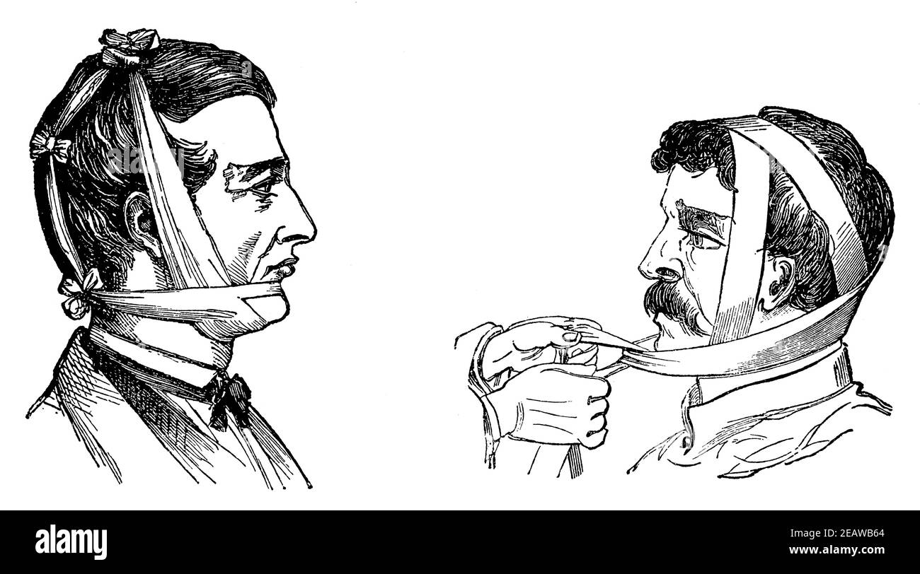 Bandages de la mâchoire inférieure cassée. Illustration du 19e siècle. Allemagne. Arrière-plan blanc. Banque D'Images