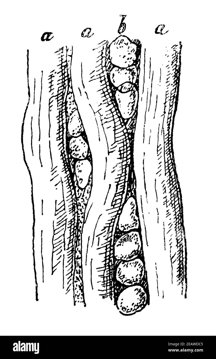 Le muscle humain est passé par les cellules graisseuses. Illustration du 19e siècle. Allemagne. Arrière-plan blanc. Banque D'Images