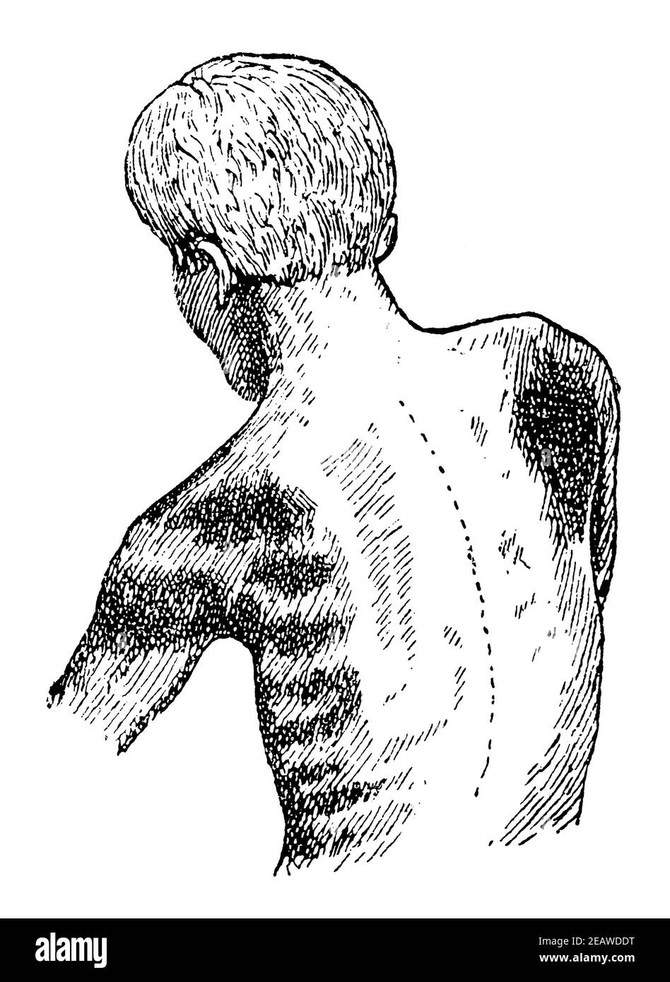 Paralysie musculaire du haut du corps d'un travailleur due à un empoisonnement chronique au mercure. Vue arrière. Illustration du 19e siècle. Allemagne. Arrière-plan blanc. Banque D'Images