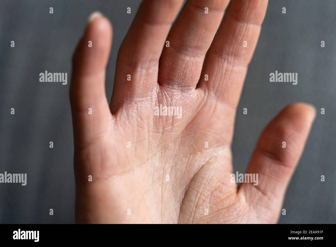 Kératose pilaris sur les mains causant une peau très sèche pendant la  saison d'hiver. L'eczéma des mains a besoin de beaucoup de soins Photo  Stock - Alamy