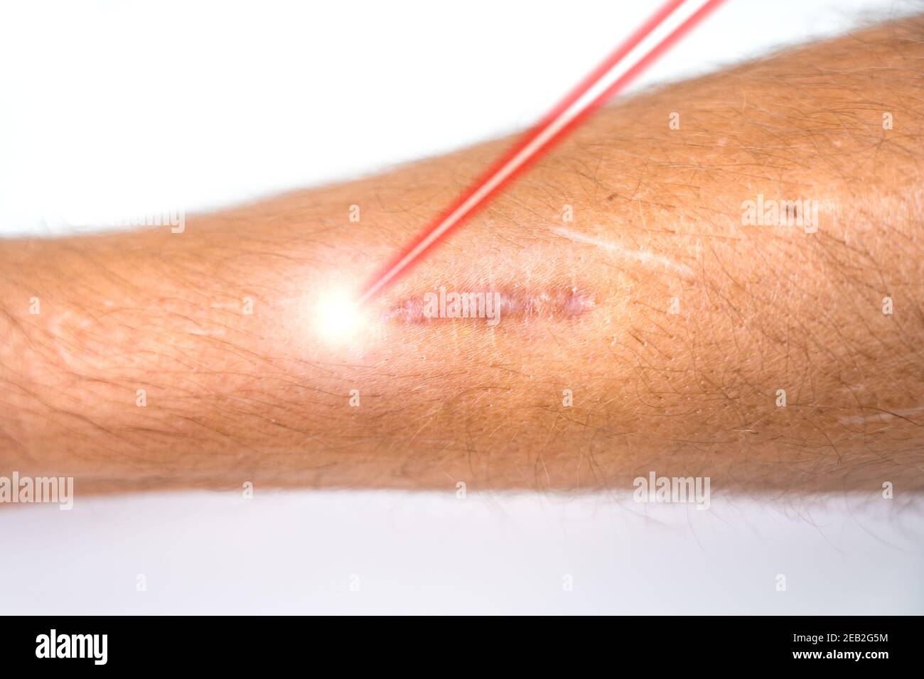 La jambe de l'homme et le faisceau laser pendant le traitement d ...