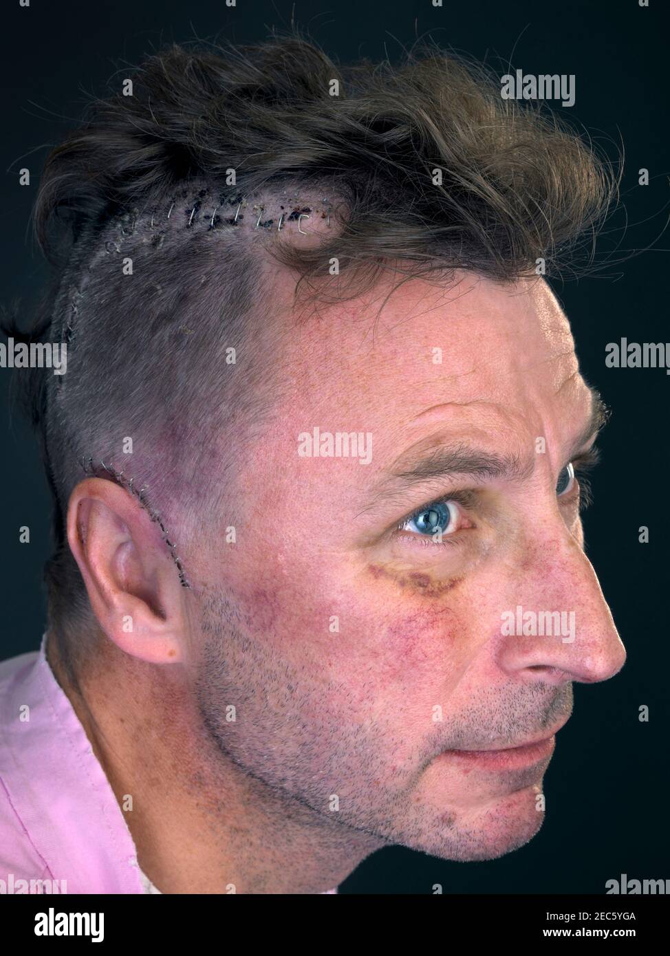 homme à tête rasée révélant une incision agrafée après une chirurgie cérébrale Banque D'Images