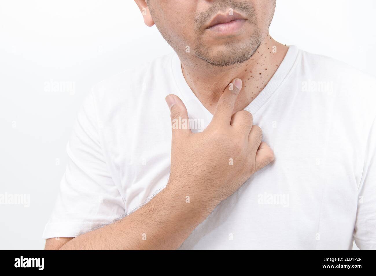 Homme pointe vers la peau Tags ou Acrochordon sur le cou homme sur fond blanc. Concept de soins de santé Banque D'Images