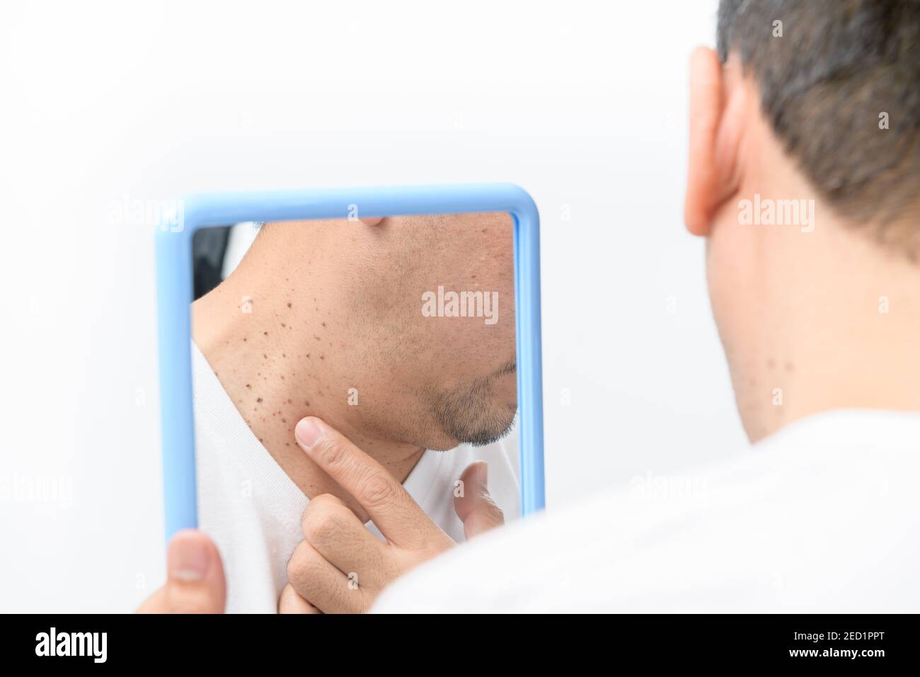 L'homme moyen asiatique regarde dans le miroir et pointe vers la peau Tags ou Acrochordon sur le cou isolé sur fond blanc. Concept de soins de santé Banque D'Images