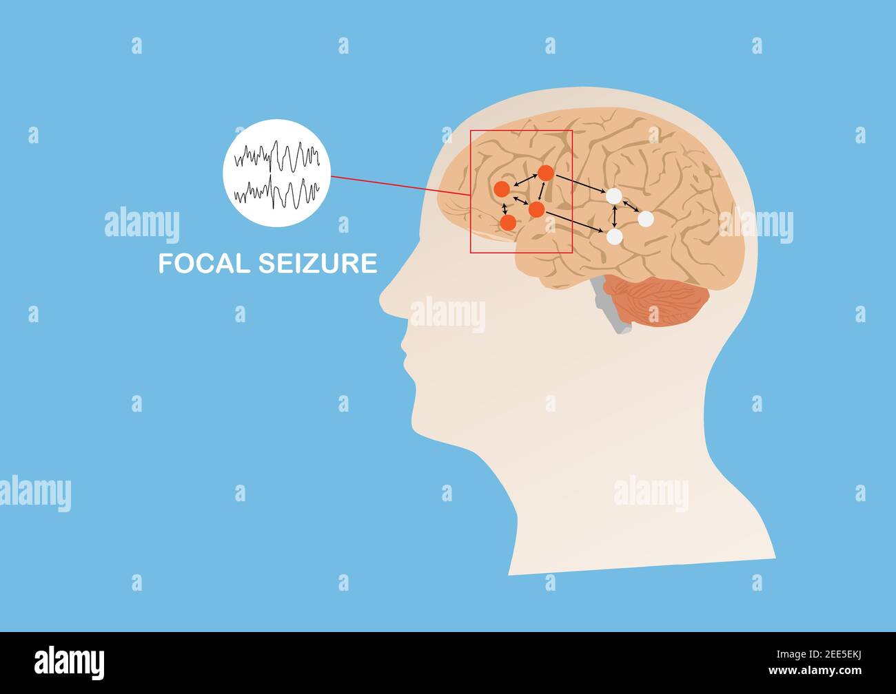 Illustration d'une activité électrique anormale dans une région du cerveau humain provoquant une crise focale ou une épilepsie. Cerveau humain et fond bleu. Illustration de Vecteur