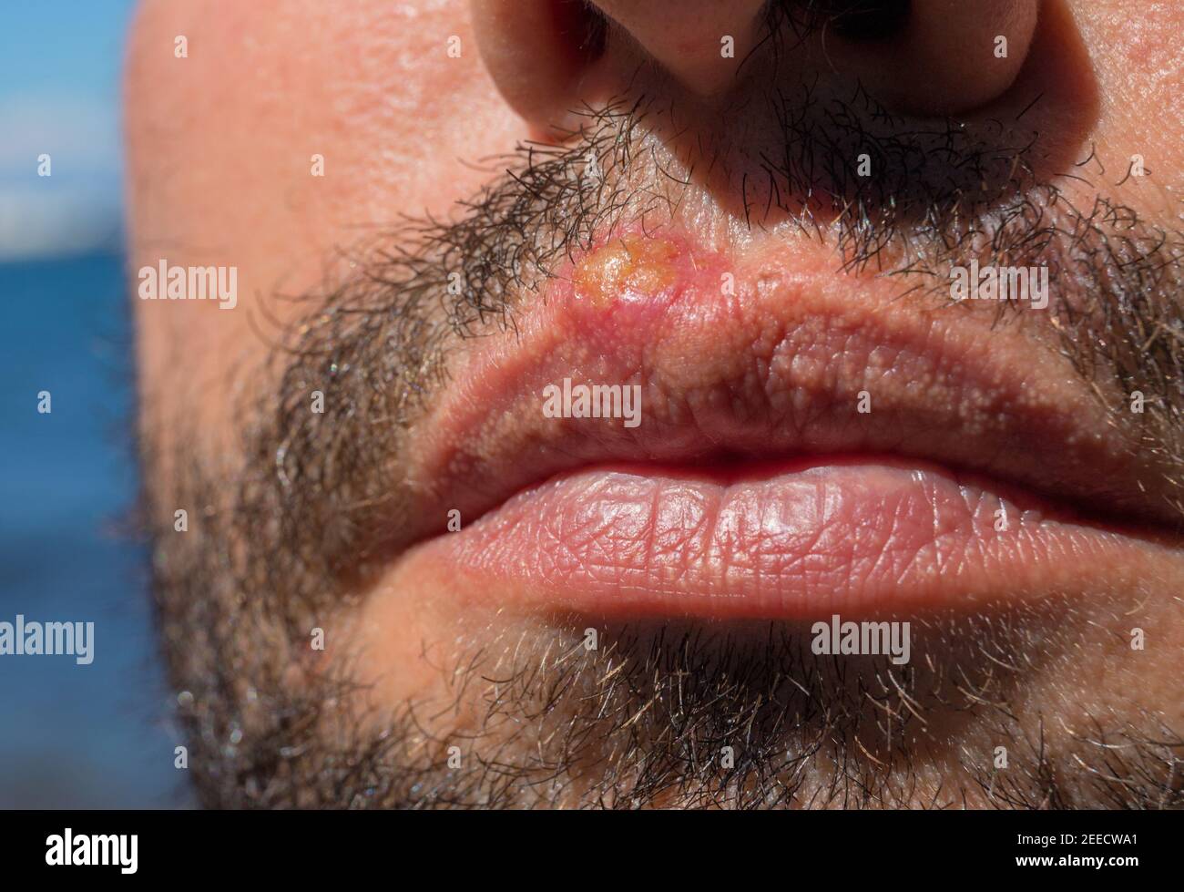 Coup de soleil sur les lvres d'homme de prs. Brlure par le soleil ou  infection bactrienne sur la peau. Problme mdical de la peau. Virus ou  inflammation bactrienne. Vacances d't sant ca