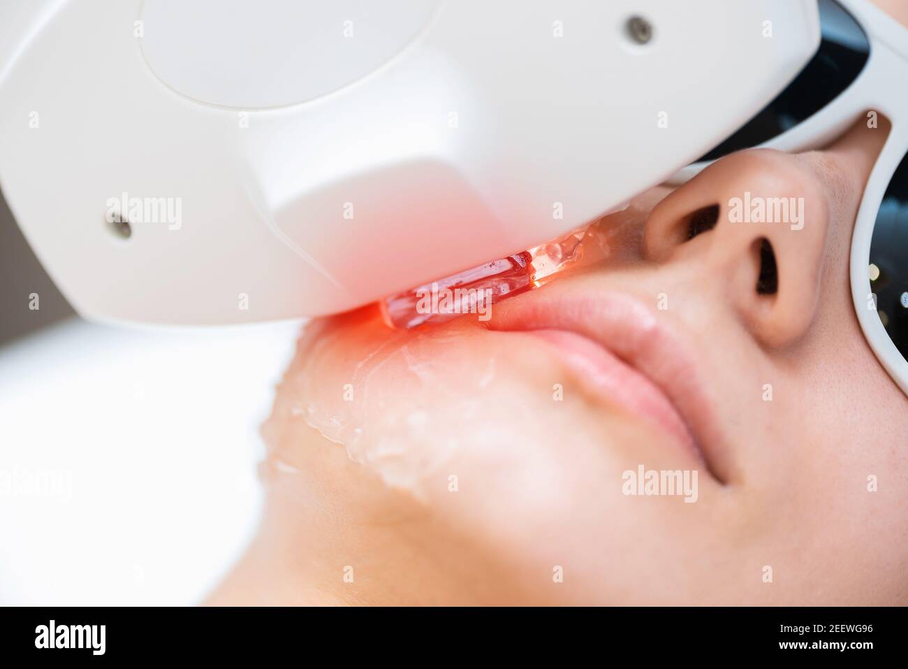 Processus de rajeunissement Elos, élimination de la pigmentation et de la proximité du réseau vasculaire. Banque D'Images