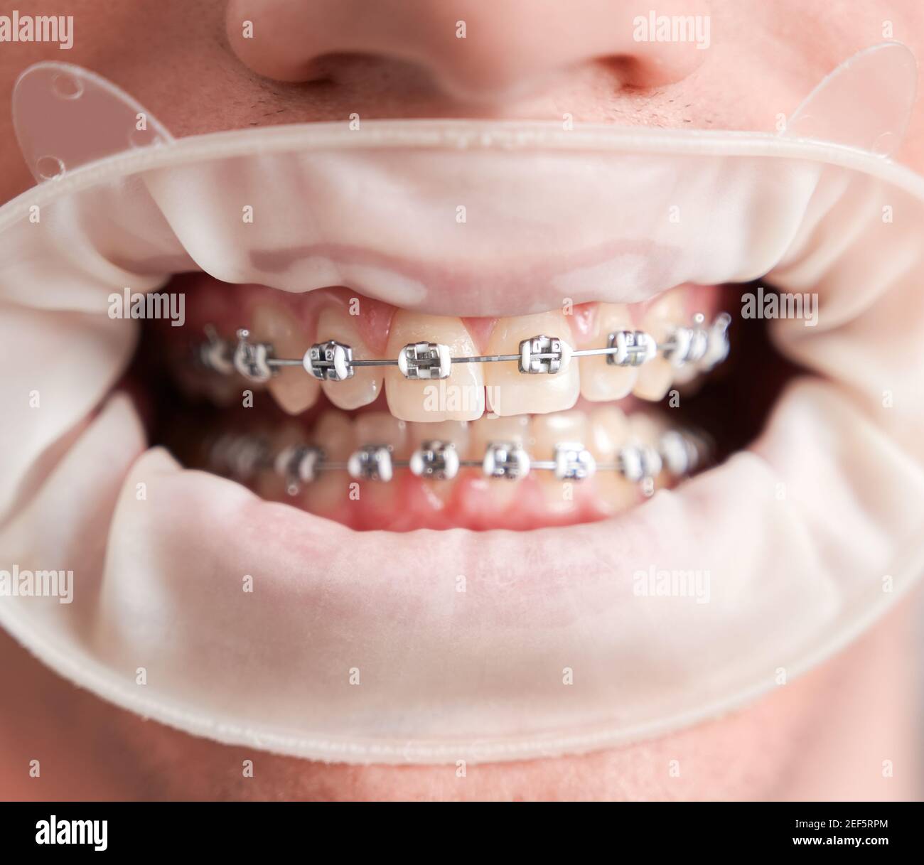 Gros plan d'un jeune homme qui fait la démonstration de dents avec des bretelles métalliques filaires. Des dents droites et saines avec des bretelles orthodontiques et un cercueil blanc. Concept de la dentisterie, de la stomatologie et du traitement orthodontique. Banque D'Images