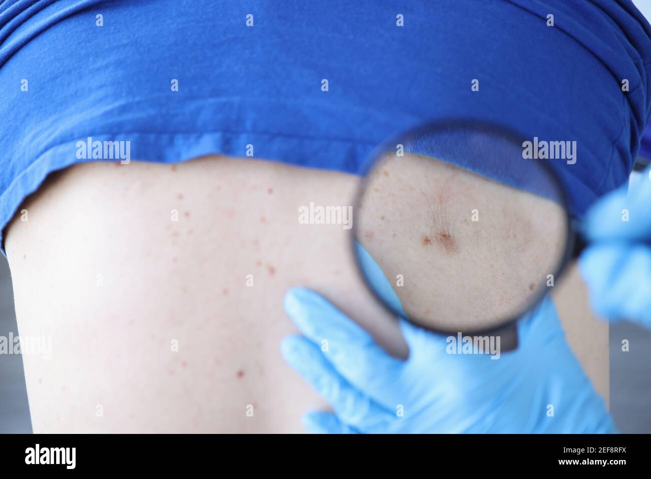 Le médecin examine le dos du patient avec des grains de beauté à travers la loupe Banque D'Images