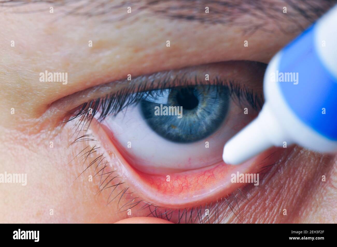 Conjunctival sac Banque de photographies et d'images à haute résolution -  Alamy