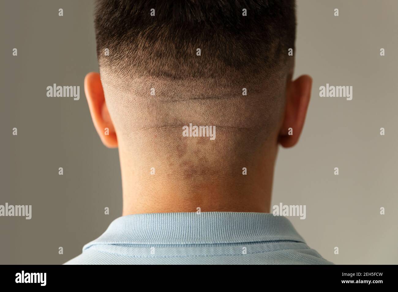 Un homme a une irritation de la peau après avoir tondu avec une tondeuse à  cheveux. Cuir chevelu sensible Photo Stock - Alamy