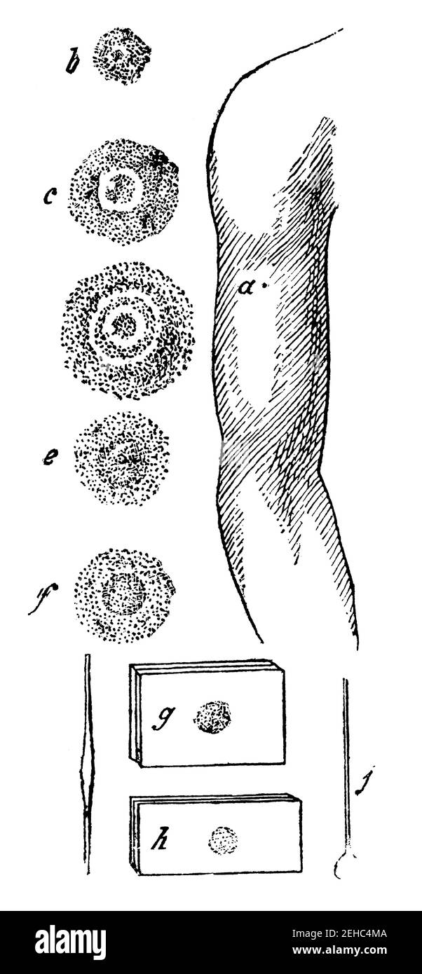 Vaccination. La réaction du corps à l'injection. Illustration du 19e siècle. Allemagne. Arrière-plan blanc. Banque D'Images