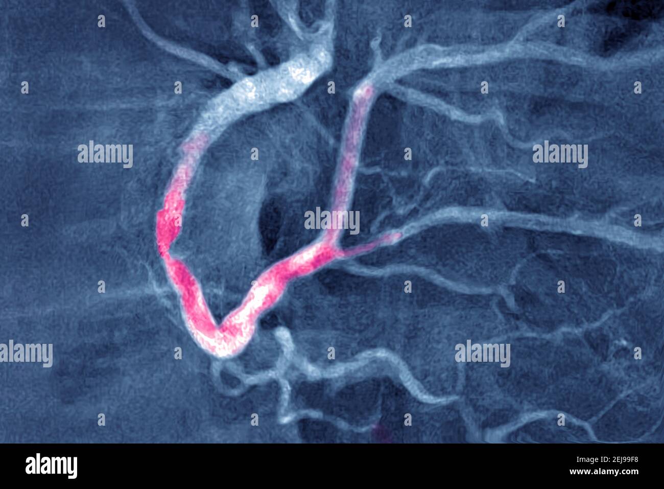 Infarctus du myocarde avec un thrombus significatif Banque D'Images