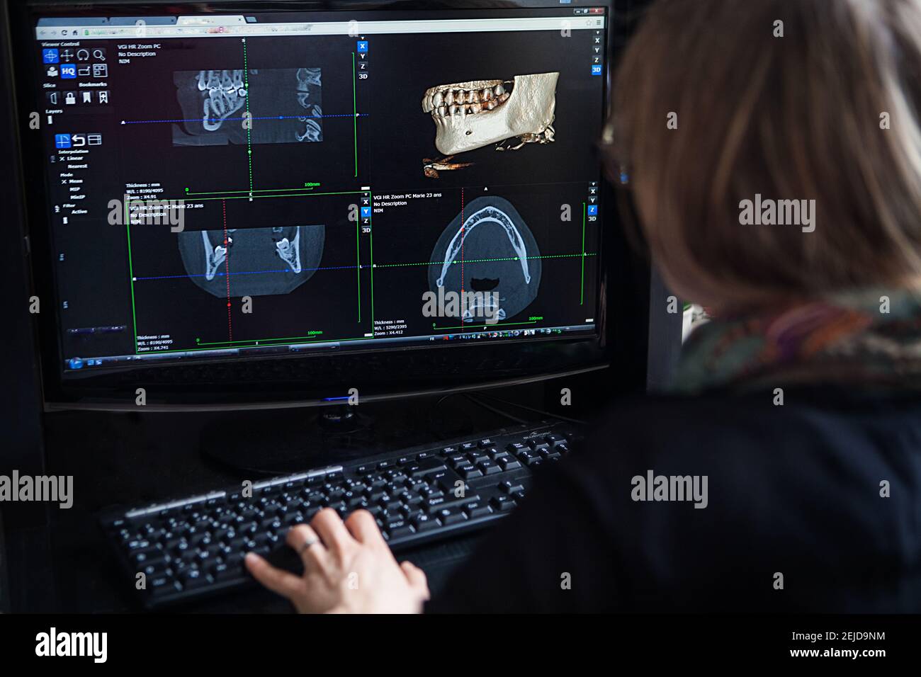 Reconstruction 3D à partir d'une image scanner de la mâchoire d'un patient pour une impression 3D personnalisée. Banque D'Images