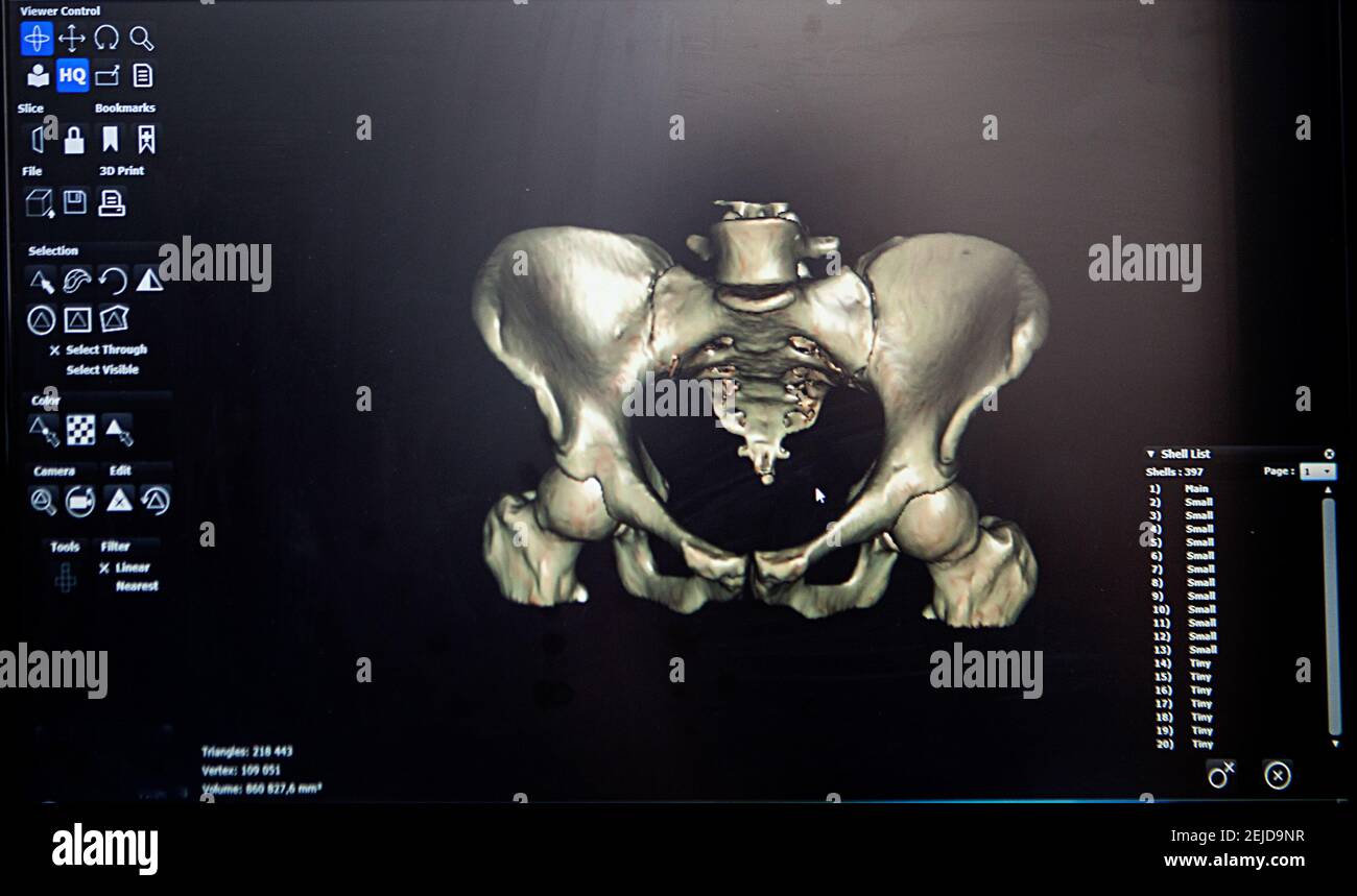 Reconstruction 3D à partir d'une image scanner du bassin d'un patient pour une impression 3D personnalisée. Banque D'Images