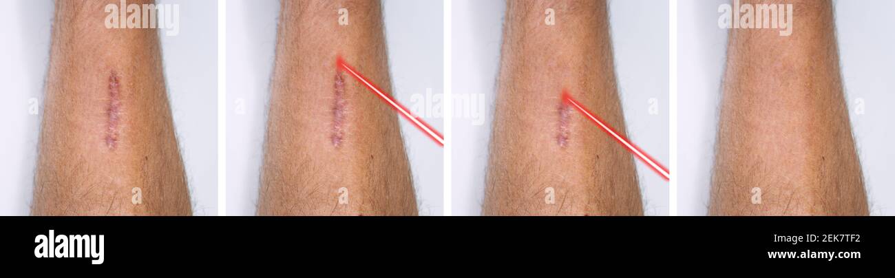 Leg surgery scar Banque de photographies et d'images à haute résolution -  Alamy