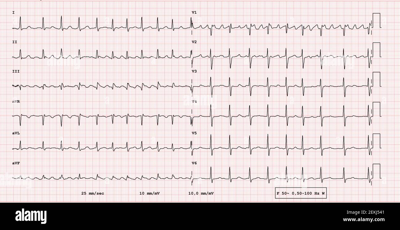 ECG exemple de rythme pathologique à 12 dérivations, flutter auriculaire Banque D'Images