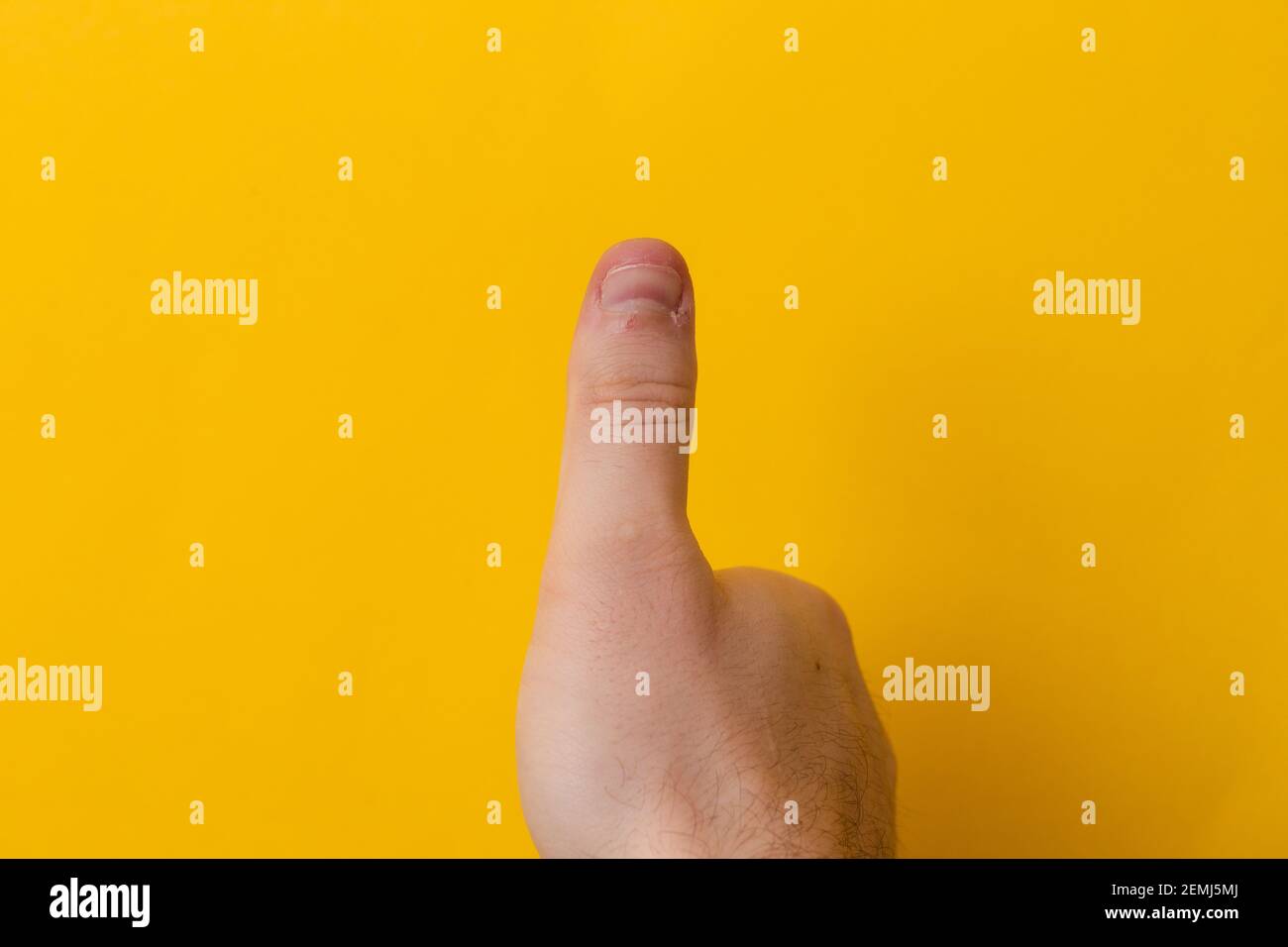 pouces vers le haut blessé ou mauvais ongle sur fond jaune. Gros plan Thumb avec mauvaise manucure gros plan Banque D'Images