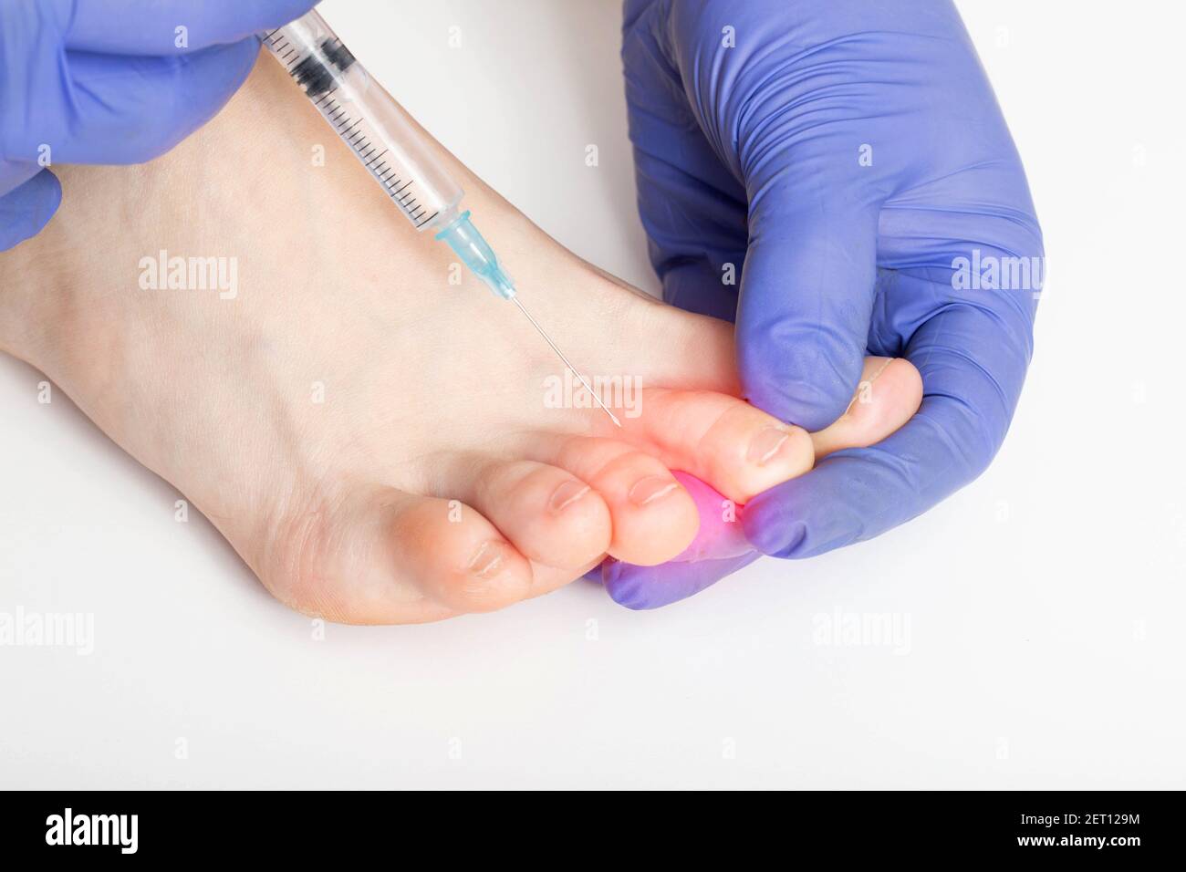 Le médecin fait une injection entre les orteils contre la transpiration de l'hyperhidrose. Concept de traitement désagréable des odeurs de pieds Banque D'Images