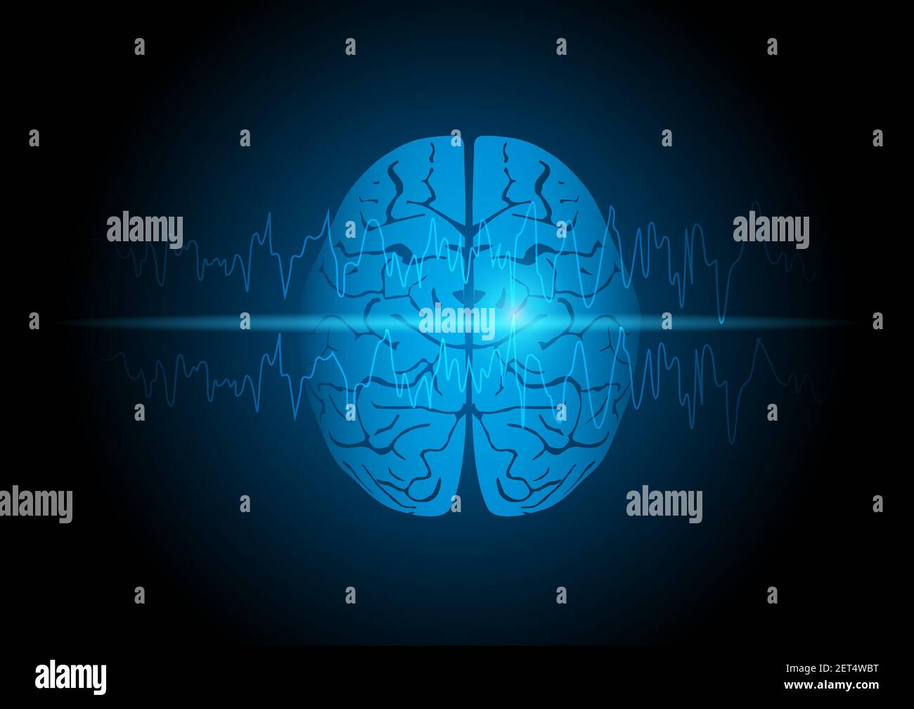 Illustration du cerveau humain avec crise focale montrant une onde anormalement vive sur l'électroencéphalographie ou l'EEG. Illustration de Vecteur