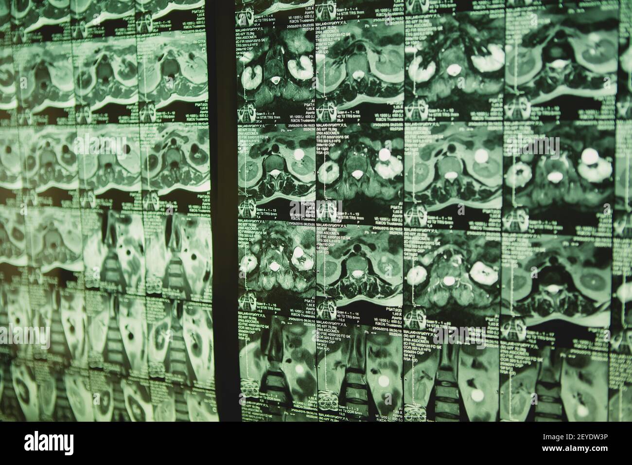 Tomodensitométrie du thorax. Antécédents médicaux. Banque D'Images