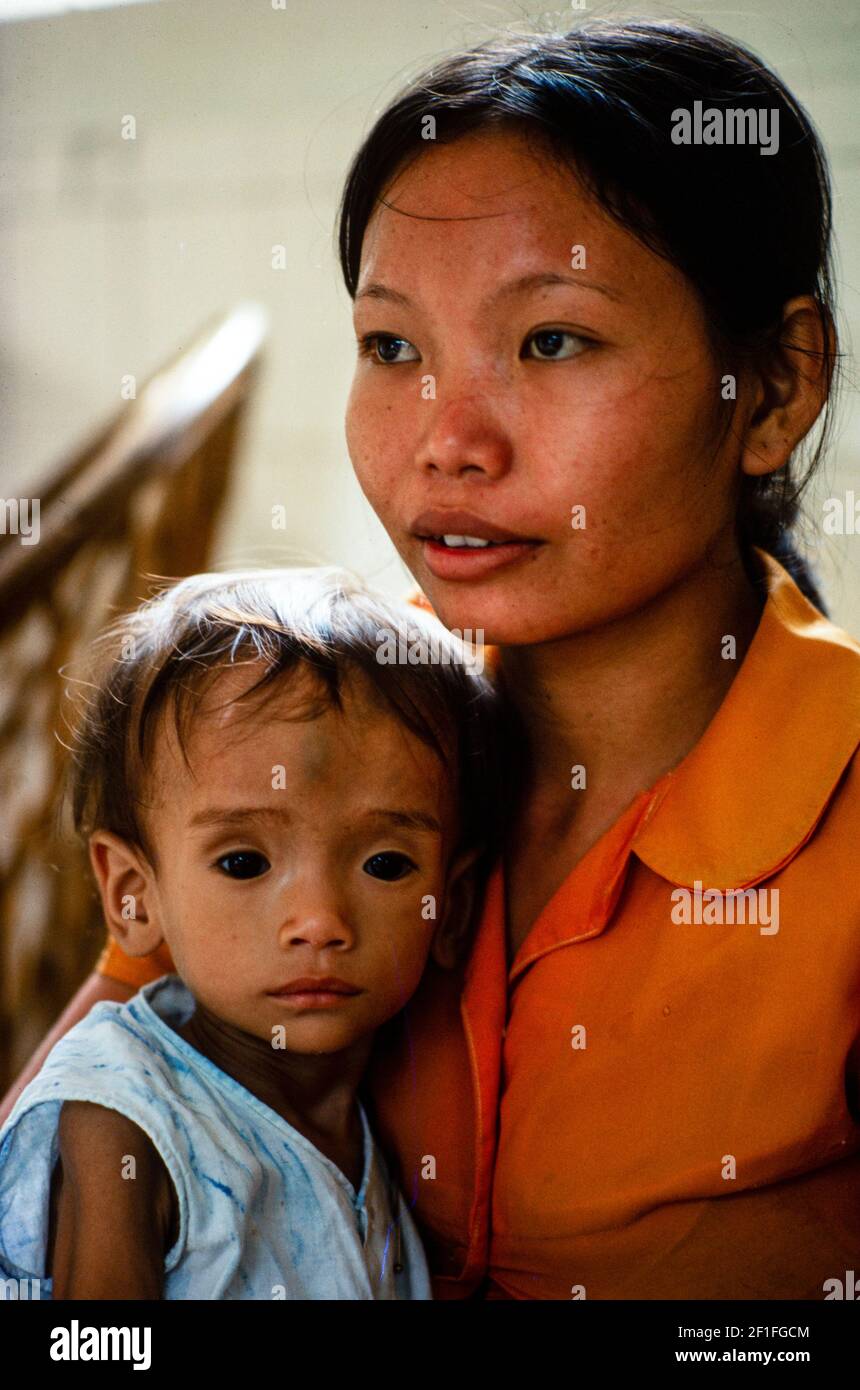 Un enfant malnutris à l'hôpital pour enfants de Ho Chi Minh ville, Vietnam, juin 1980 Banque D'Images Un enfant malnutris à l'hôpital pour enfants de Ho Chi Minh ville, Vietnam, juin 1980 Banque D'Images