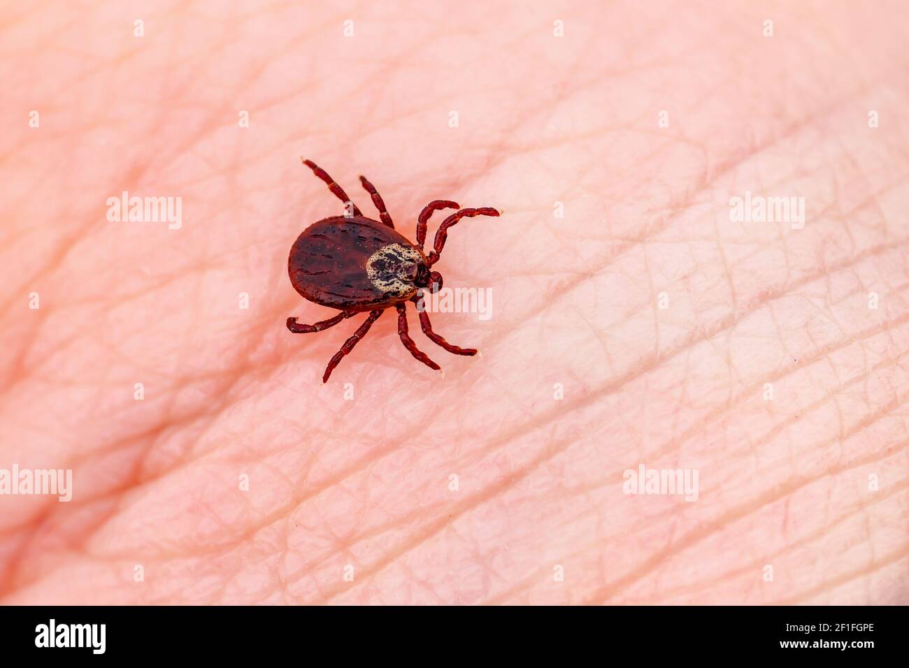 Virus de l'encéphalite japonaise ou la maladie de Lyme tiques Dermacentor infectieuses arachnide insecte parasite sur la peau Macro Banque D'Images