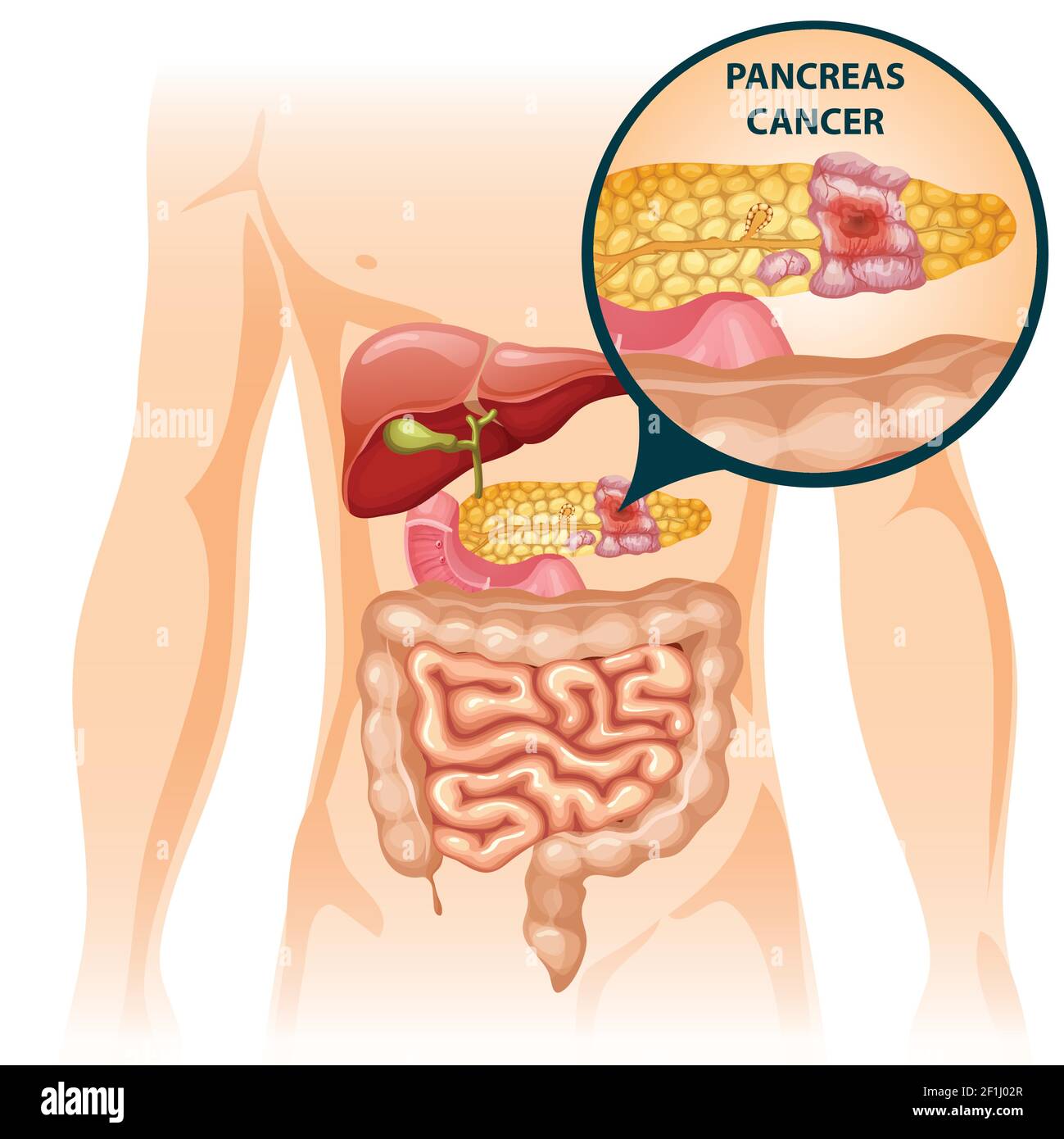 Caricature digestive organes humains concept avec foie intestin estomac et illustration du vecteur du pancréas malade Illustration de Vecteur