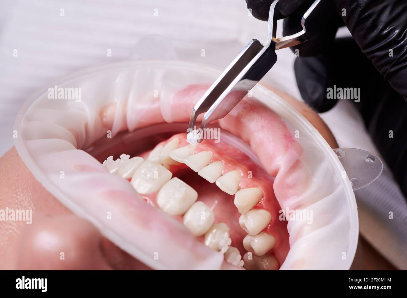 Gros plan des appareils orthodontistes qui mettent les dents de la femme.  Patient avec un écarteur de joue dans la bouche et des supports  orthodontiques sur les dents à la clinique dentaire.