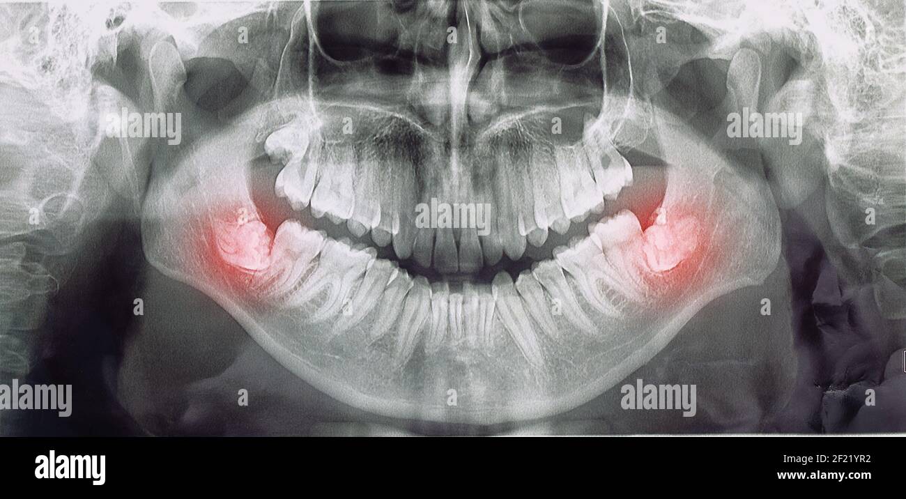 Différents types de sagesse dents problèmes concept, problème dents X-ray image scannée, image panoramique Banque D'Images