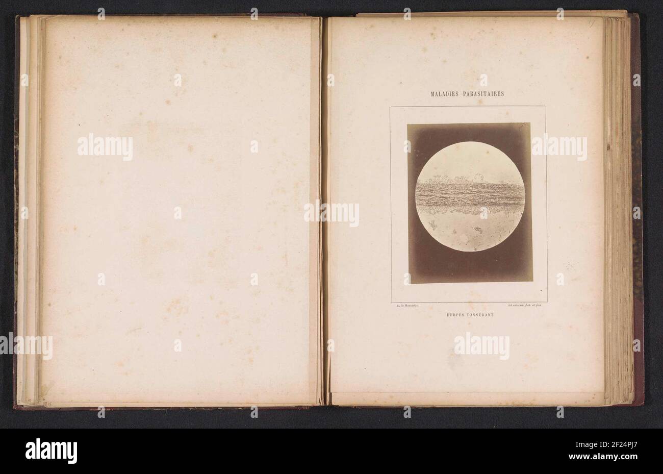 Absorption au microscope de la teigne tonsurante sur la tête; Herpès tonsurant .. Banque D'Images