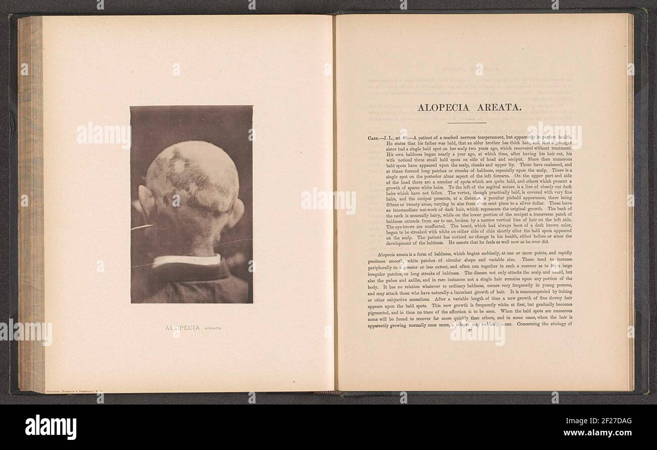 Patient souffrant de la maladie de la peau 'Alopecia areata'; Alopecia areata .. Banque D'Images